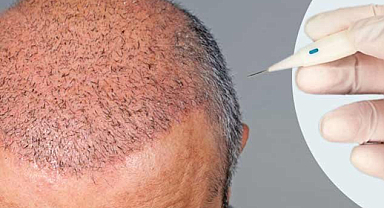 Saç Ekimi Uygulamalarında Sağlık Bakanlığı Yönetmeliği Değiştirdi