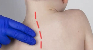 Skolyoz Tedavisinde Erken Tanı ve Tedavi Önemli...