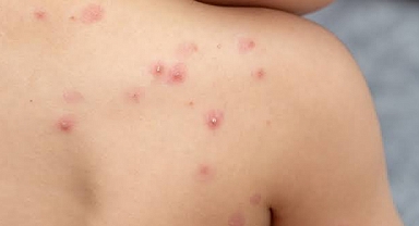 Çocukluk dönemi aşı takvimi değişti: Suçiçeği aşısında ikinci doz dönemi